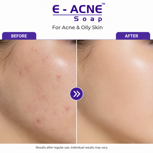 E Acne Soap, Oily & Acne Prone Skin, White, 75g